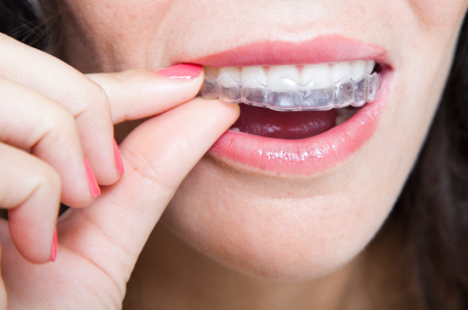 Know More About the Invisalign Process! - Kuna, ID