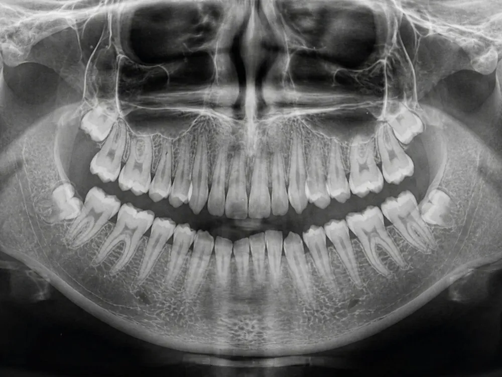 Panoramic dental X-ray — honest exam at Deluxe Dental Kuna Idaho dentist.