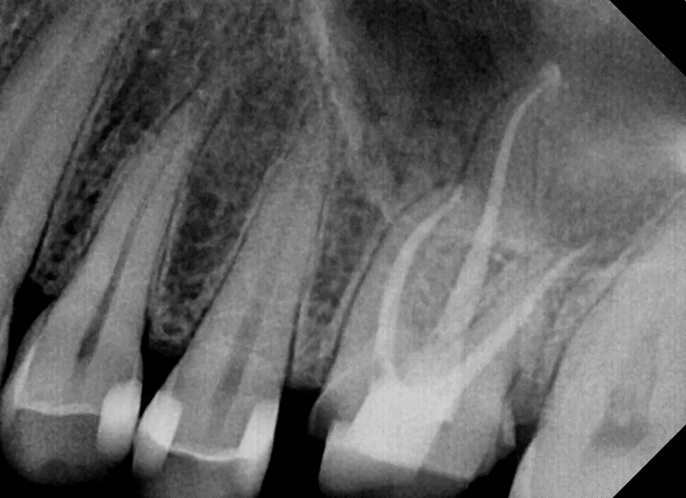 Root canal treatment performed at Deluxe Dental — endodontic care Kuna Idaho dentist