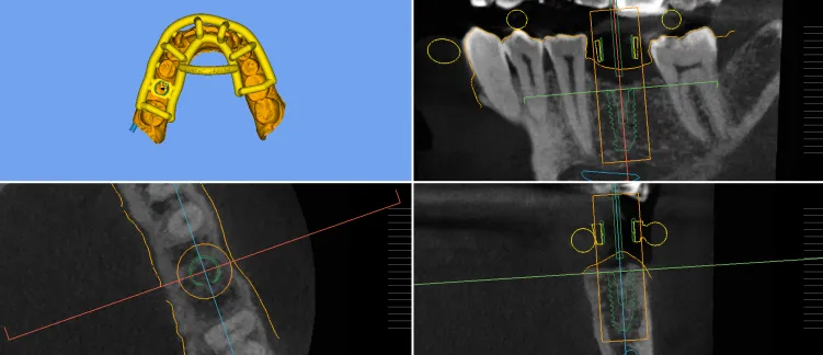 MIS dental implant system used at Deluxe Dental — dental implants Kuna Idaho