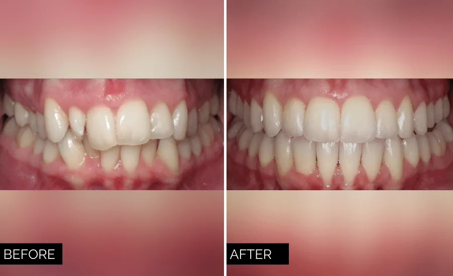 Invisalign clear aligners — straighten your smile at Deluxe Dental Kuna Idaho cosmetic dentist